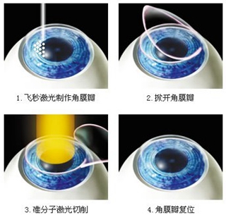 近视眼激光手术安全吗？